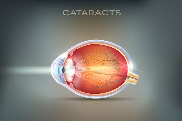 breaking down the myths about aging and cataracts