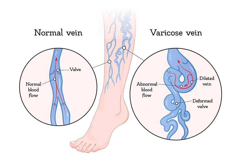 varicose veins poster