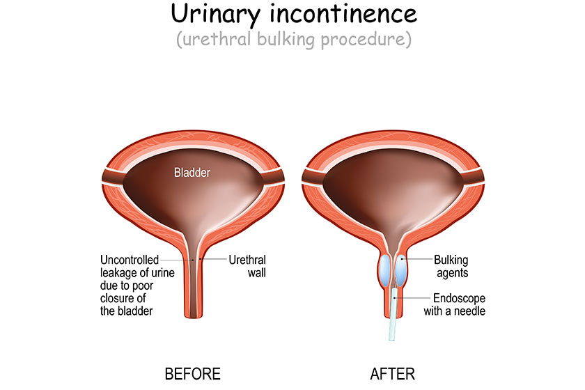 how assisted living in charlotte nc can help seniors with incontinence img how assisted living in charlotte nc can help seniors with incontinence img