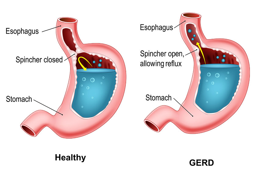 gastroesophageal reflux disease
