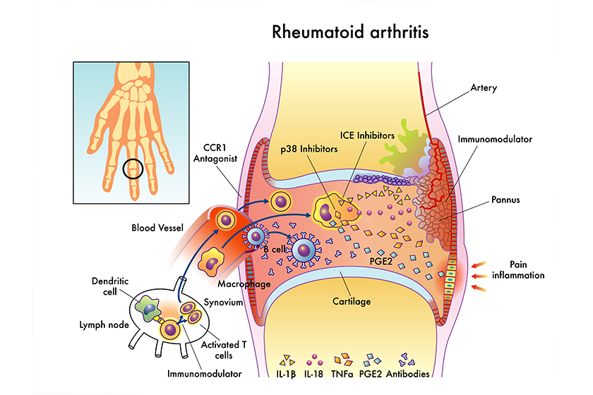 rheumatoid arthritis