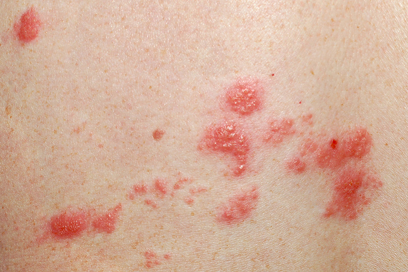 shingles sores
