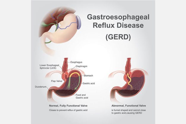 gastroesophageal reflux disease gerd also known acid reflux long term gastroesophageal reflux disease gerd also known acid reflux long term