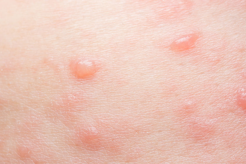 how seniors can prevent impetigo while living in a senior community in img how seniors can prevent impetigo while living in a senior community in img