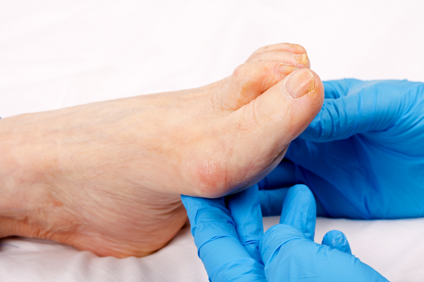 how simple lifestyle changes can prevent chronic foot pain
