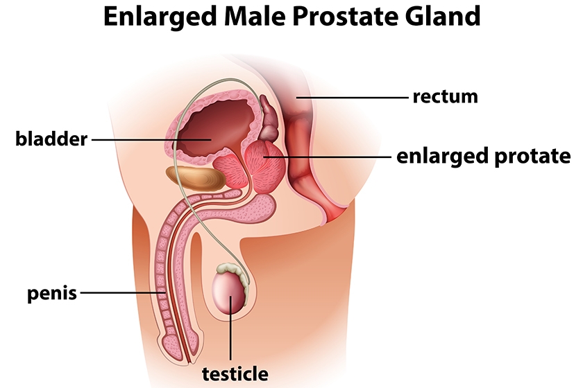 enlarged male prostate gland enlarged male prostate gland