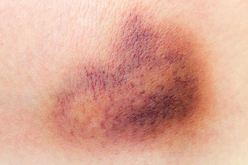 bruise on skin
