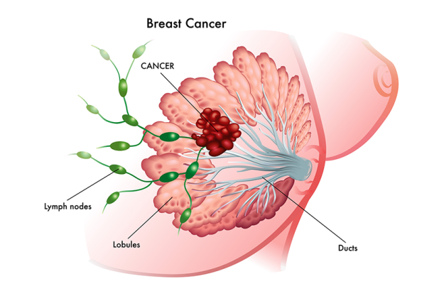 breast cancer breast cancer