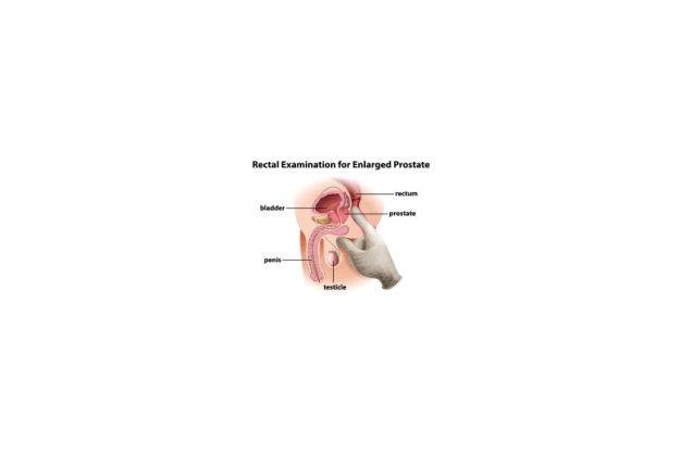 Rectal Examination for Enlarged Prostate