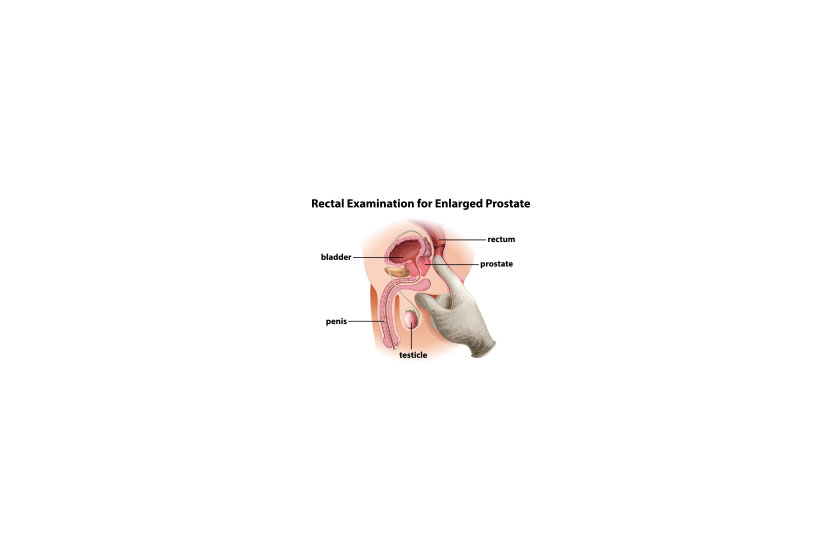 Rectal Examination for Enlarged Prostate