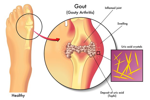 detailed human gout