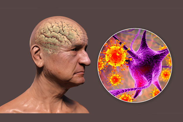 infectious etiology dementia conceptual illustration