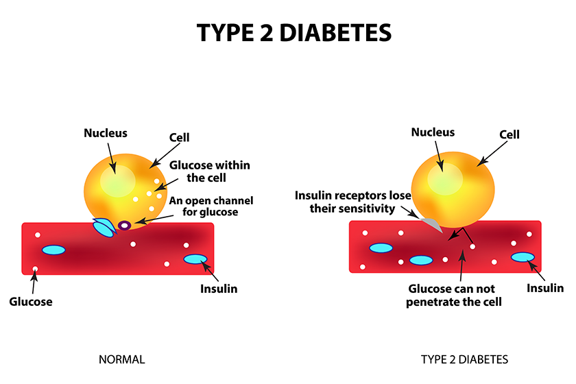 the absorption of glucose by the cell type 2 diabetes