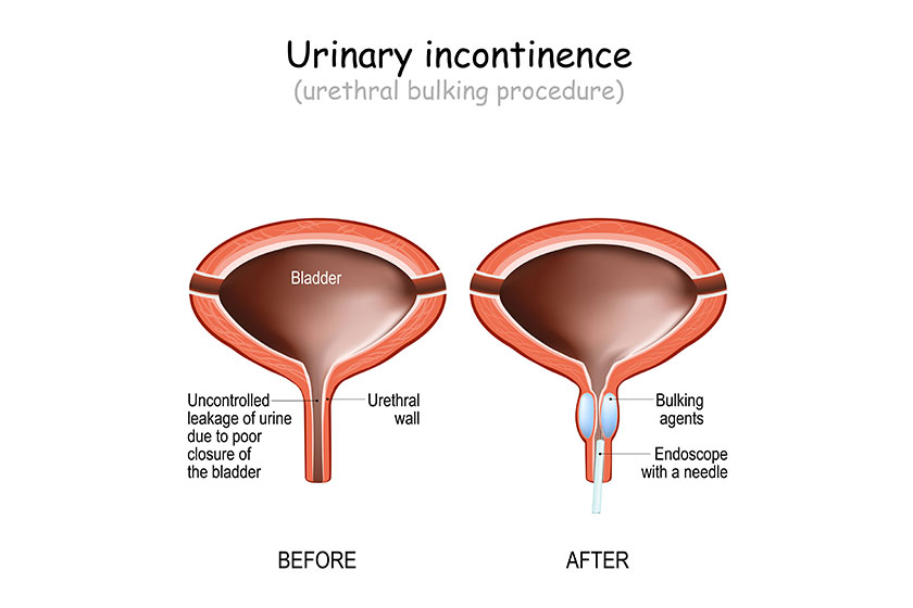 Urinary incontinence involuntary urination uncontrolled leakage urine human urinary bladder Urinary incontinence involuntary urination uncontrolled leakage urine human urinary bladder