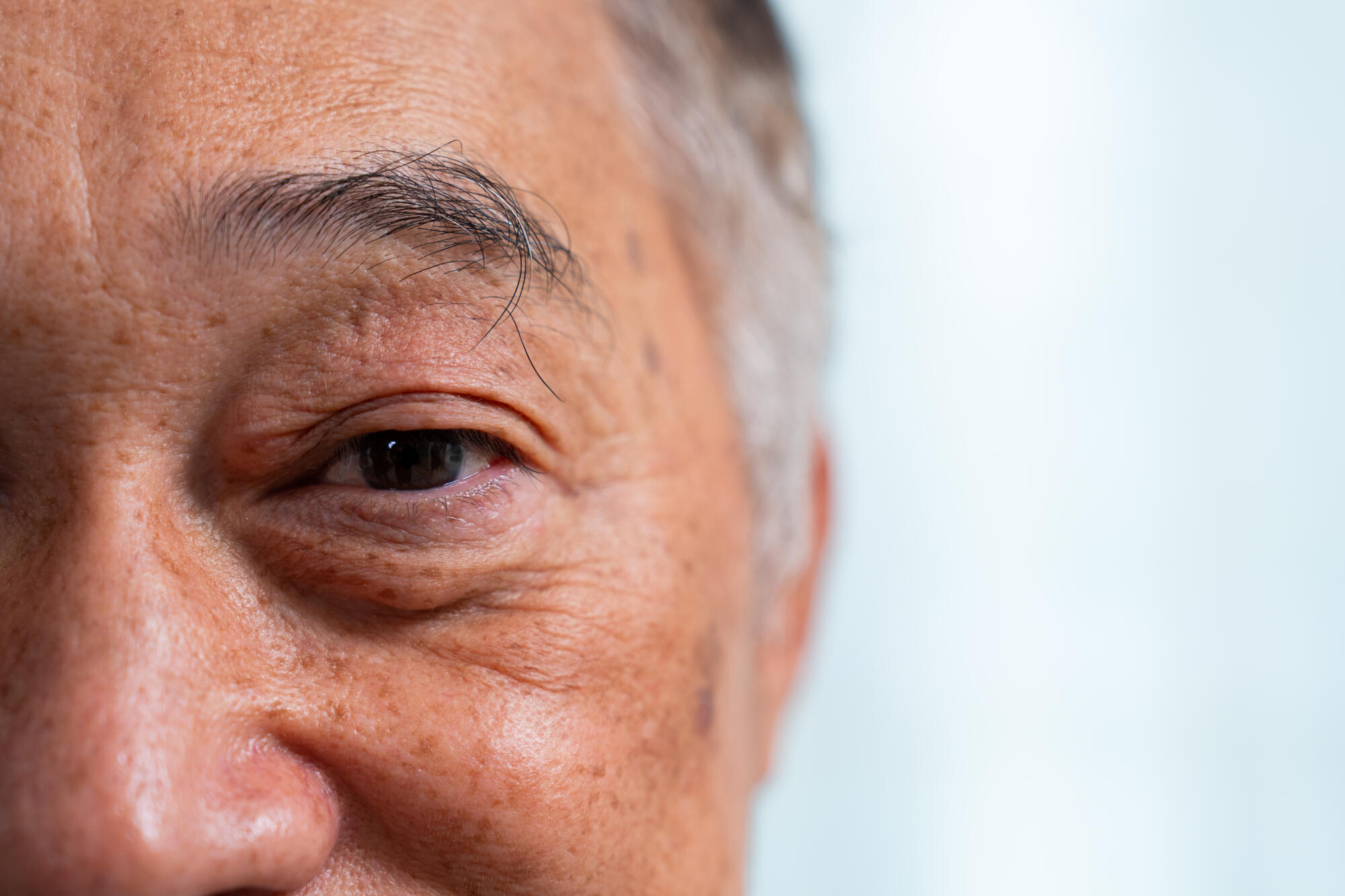 fast growing cataracts (1) fast growing cataracts (1)